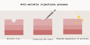 Anti-wrinkle injections process graphic image